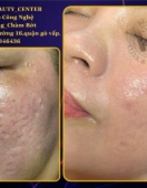 Sẹo Rỗ/ Sẹo Lõm là gì? 